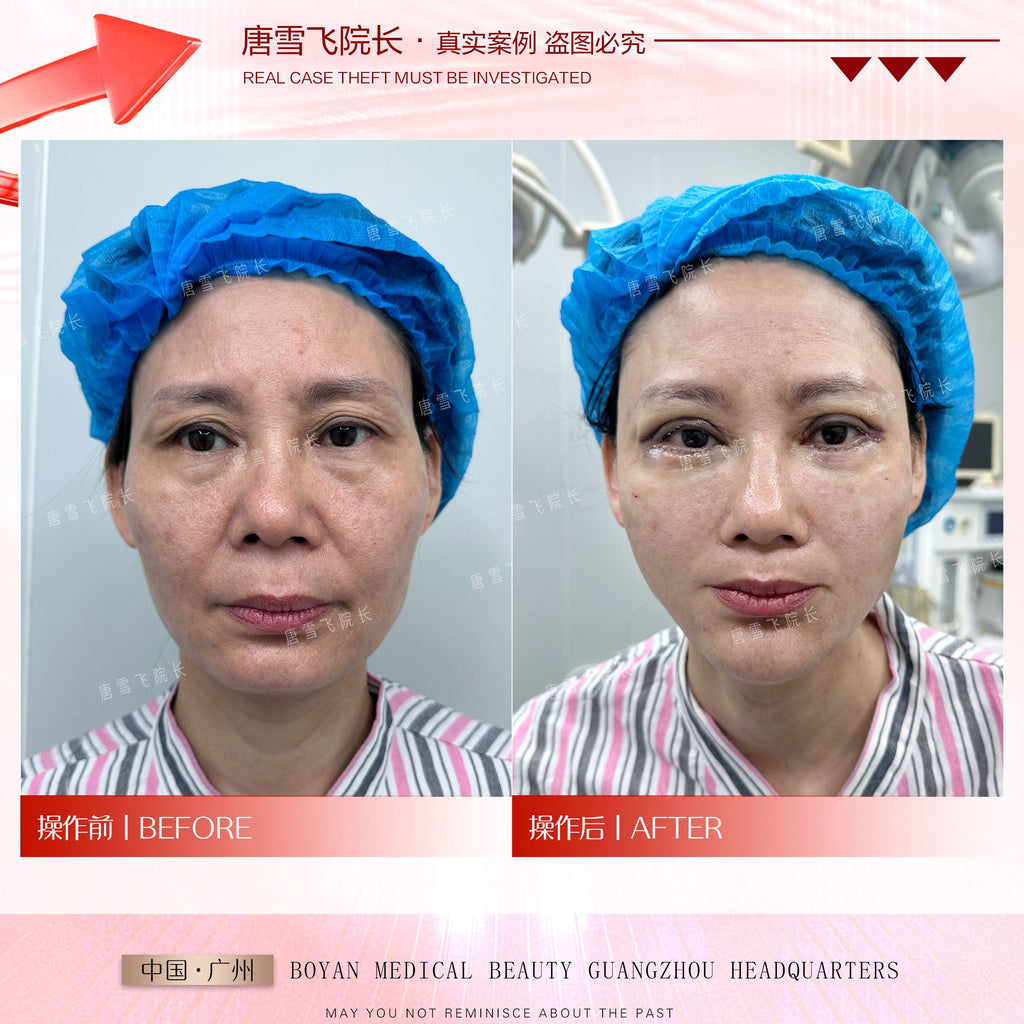 Surgical Youth Anchor Lift（外科青春铆钉提升术）