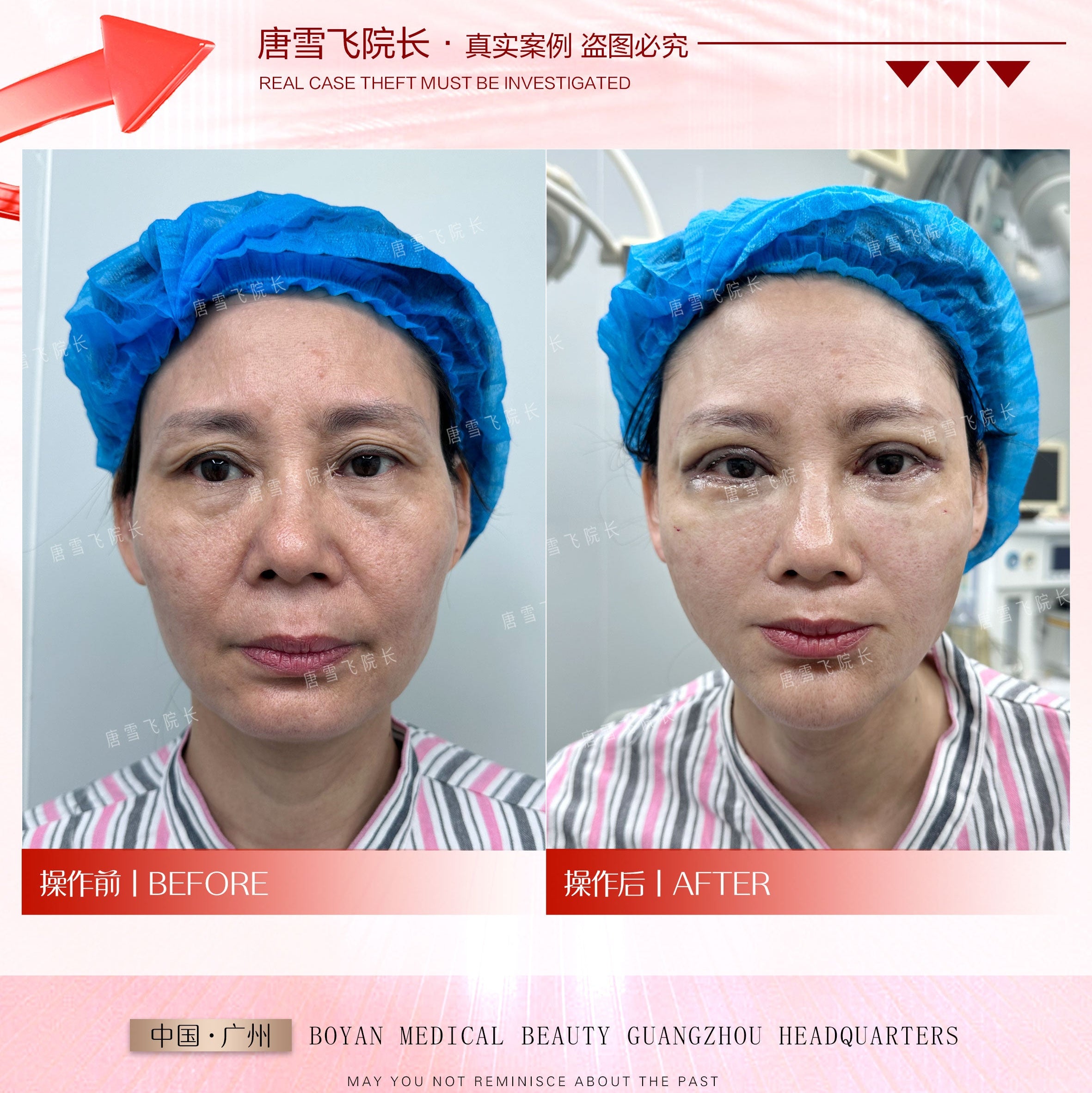 Surgical Youth Anchor Lift（外科青春铆钉提升术）