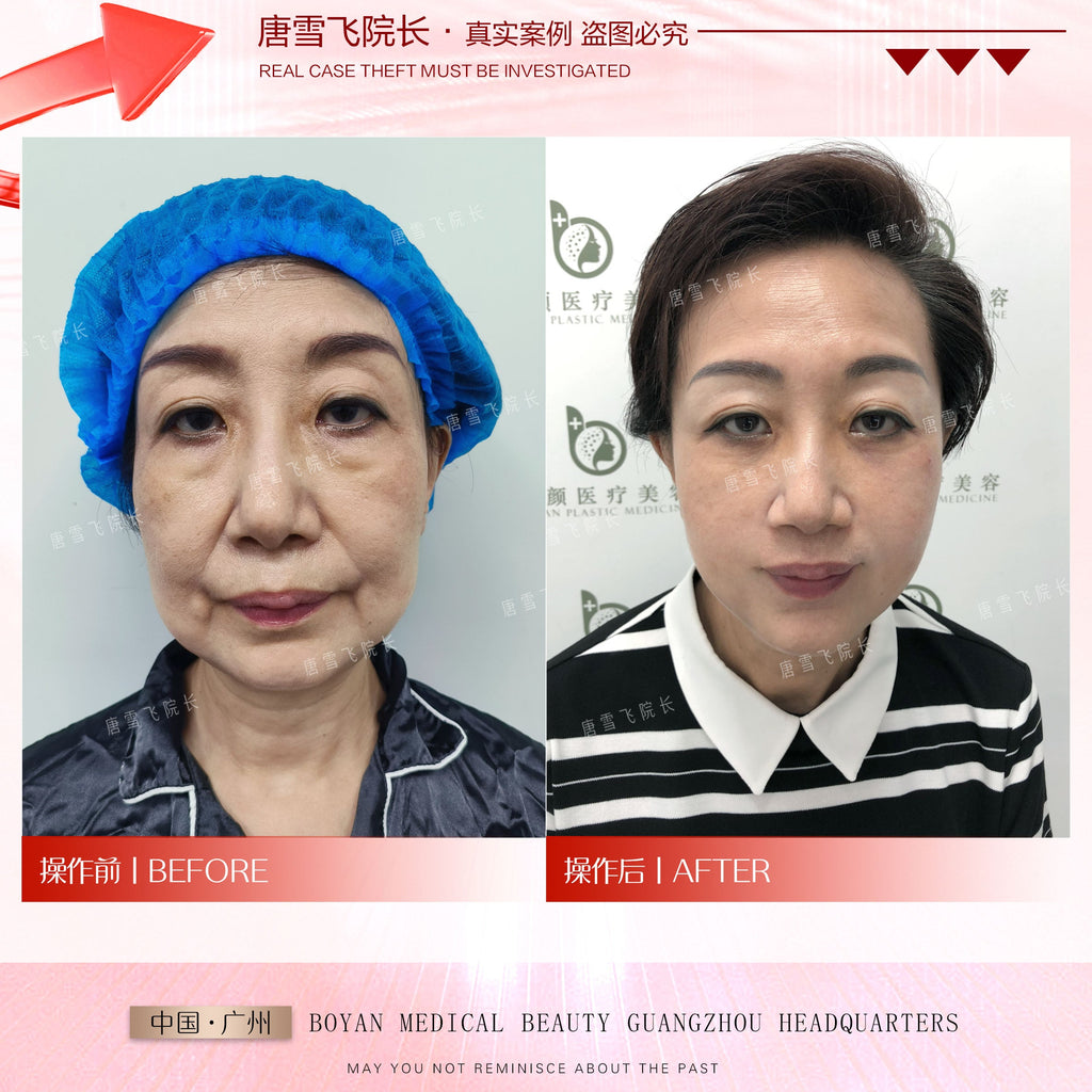 Surgical Youth Anchor Lift（外科青春铆钉提升术）