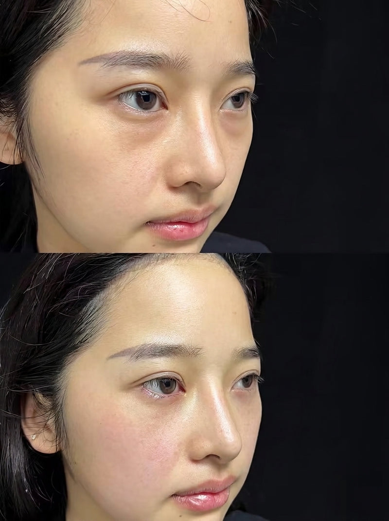Deer Eyes Selepas pembedahan