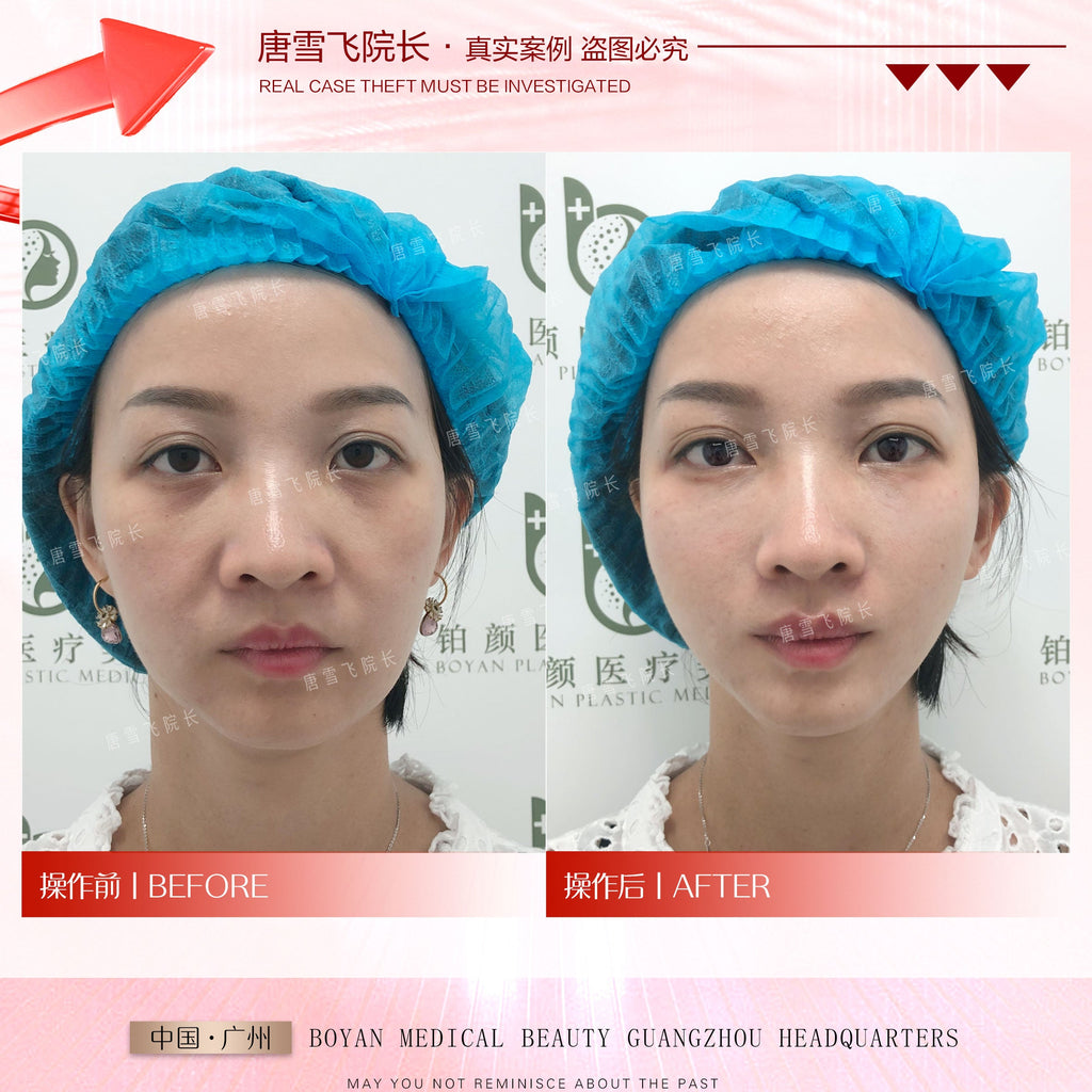 Surgical Youth Anchor Lift（外科青春铆钉提升术）