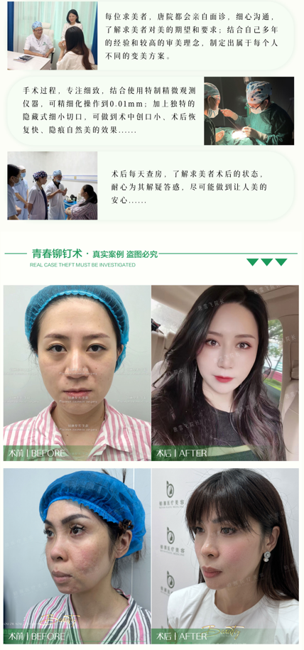 青春铆钉提升术