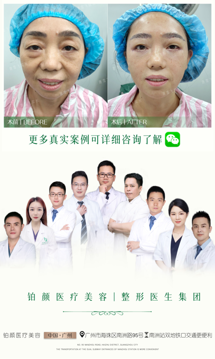 青春铆钉提升术
